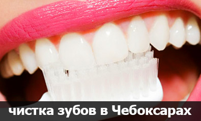 профессиональная чистка зубов в Чебоксарах