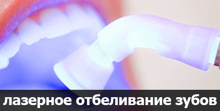 лазерное отбеливание зубов в Чебоксарах