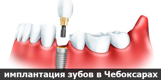 процесс имплантации зубов в Чебоксарах