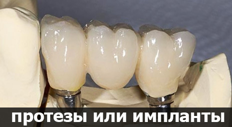 отличия имплантации от протезирования зубов