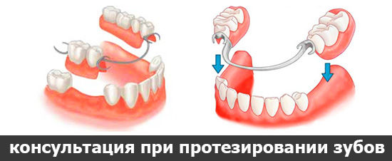 консультация при протезировании зубов в Чебоксарах