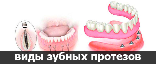 виды зубных протезов